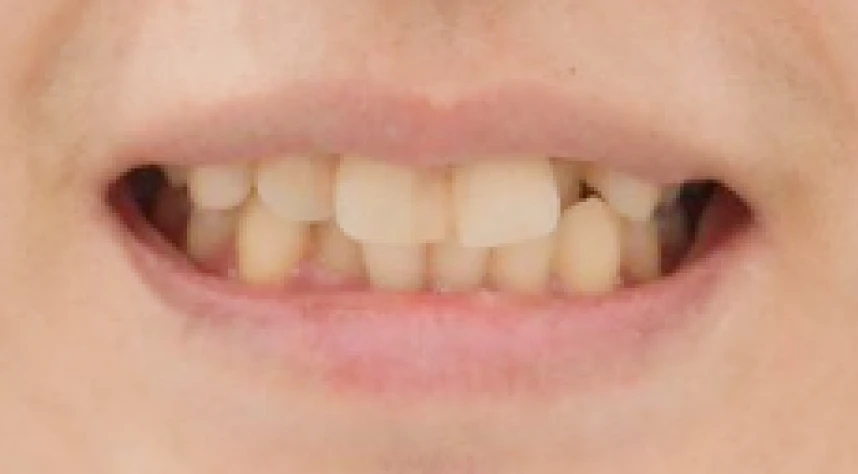 矯正治療前の口元の写真（Before）