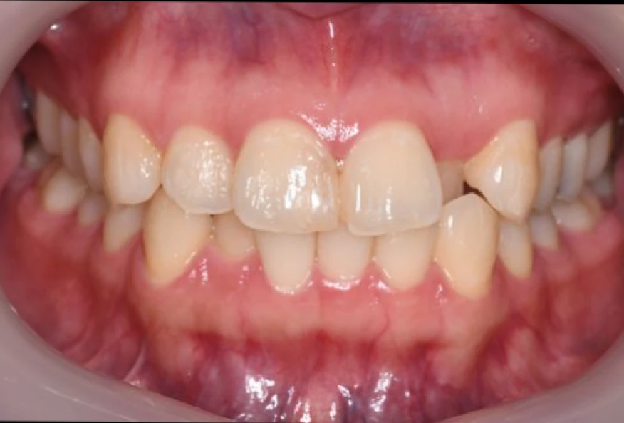 矯正治療前の歯列写真（Before）