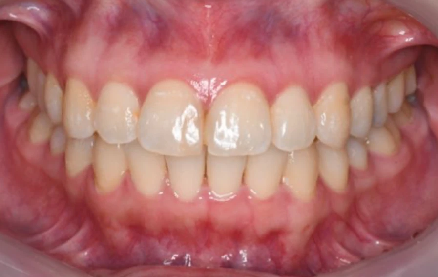 矯正治療後の歯列写真（After）