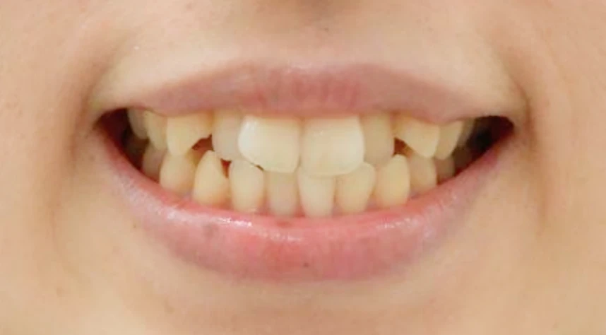 矯正治療前の口元の写真（Before）