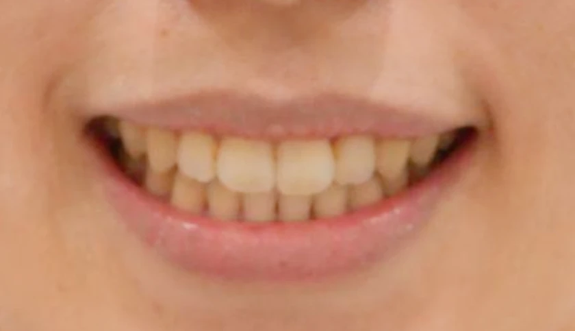 矯正治療後の口元の写真（After）