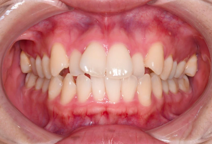 矯正治療前の歯列写真（Before）